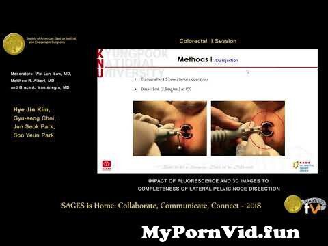 Impact of fluorescence & 3D images to completeness of lateral pelvic node dissection from imagetwist nude фрукт ru lsp model jpegex Watch Video - MyPornVid.fun