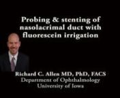 This is Richard Allen at the University of Iowa. This video demonstrates probing and stenting and also flouroscein irrigation in a patient with a unilateral congenital nasolacrimal duct obstruction.A punctal dilator is placed vertically and then horizontally. The same is done on the upper lid.A number one bowman probe is then introduced through the canaliculus where a hard stop is appreciated.The same is done on the upper lid.Fluoroscein is then introduced and injected through the lower