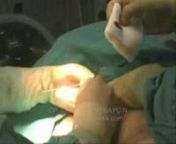 Koltukaltından silikon yerleştirerek göğüs üzerinde hiç iz oluşturmadan göğüs büyütme ameliyatı yapıyor, ünlü estetik cerrah Op. Dr. H. Nazmi Bayçın video görüntüleri izle.nhttp://www.gogusbuyutme.com.tr