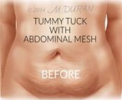 Animated medical illustration showing before and after and surgical steps for tummy tuck for sagging belly; abdominal wall reconstruction. Inserting abdominal mesh. Biotechnology; General surgery; plastic surgery; female figure; maternal/child; reconstructive surgery; SERI mesh; product demonstration; patient education; aesthetics. © 2014 Mica Duran. All rights reserved. https://www.micaduran.com