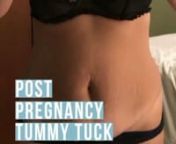 Pregnancy left this woman with a belly pouch, stretchmarks, and loose skin. A tummy tuck with muscle repair helped her regain a tighter, more athletic abdomen that no amount of exercise could achieve. Exercise burns fat and tones muscles, will never tighten skin or repair separated rectus muscles