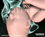 This 3D medical animation shows the common indications for a cesarean delivery, including dystocia, placenta previa, fetal distress and multiple births. A cesarean section (c-section) surgery to deliver a baby in frank breech (feet first) position is also shown. During the procedure, the surgeon (usually an obstetrician/gynecologist, i.e. ob/gyn) makes an incision in the abdominal wall and uterus in order to deliver the baby. The animation also includes information on what to expect before and a