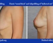 KEYWORDS: Breast adipofilling, breast conization, emptied breasts, elastic suture, breast ptosisnThe emptied breasts can be aesthetically improved with conization, performed with the Elasticum suture and Adipofilling of small lobular fragments. The conformation of the breasts is always performed together with Adipofilling because it allows the fat to be grafted where it is necessary to have the best aesthetic result.