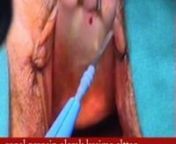 Vaginal Operation - Jinekodoktor.com