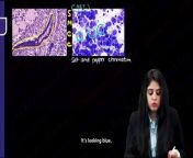 Pulmonary hypertension \ \respiratory system RS \ \lung pathology from lung danc