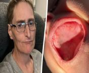 A nurse left unable to eat after a dentist extracted nearly all her teeth says she&#39;s had to retire early due to suspected malnutrition.&#60;br/&#62;&#60;br/&#62;Annette Aldridge, 55, went to the dentist with a loose tooth and was shocked when she was told her all her teeth would be needed to be taken out due to infection.&#60;br/&#62;&#60;br/&#62;The soon to be retired dermatology nurse was given dentures - but said they don&#39;t fit in her mouth and keep falling out.&#60;br/&#62;&#60;br/&#62;Four months after she had nearly all her teeth removed, she lost two stone because she&#39;s barely able to eat, and is being investigated for malnutrition, she said.&#60;br/&#62;&#60;br/&#62;She has just one molar and two front teeth and has taken early retirement due to sheer exhaustion.&#60;br/&#62;&#60;br/&#62;Annette from Epping, Essex, said: &#92;